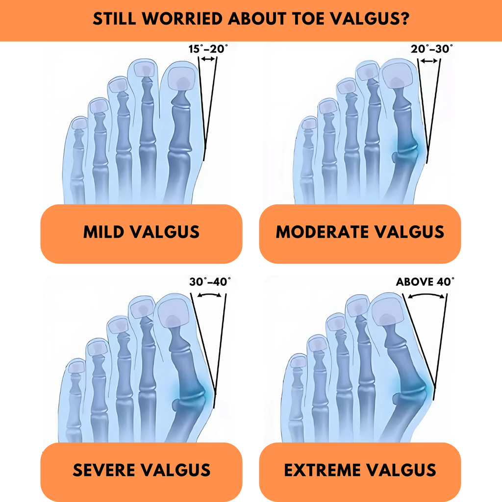 Orthopaedic Toe Bunion Corrector