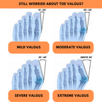 Orthopaedic Toe Bunion Corrector