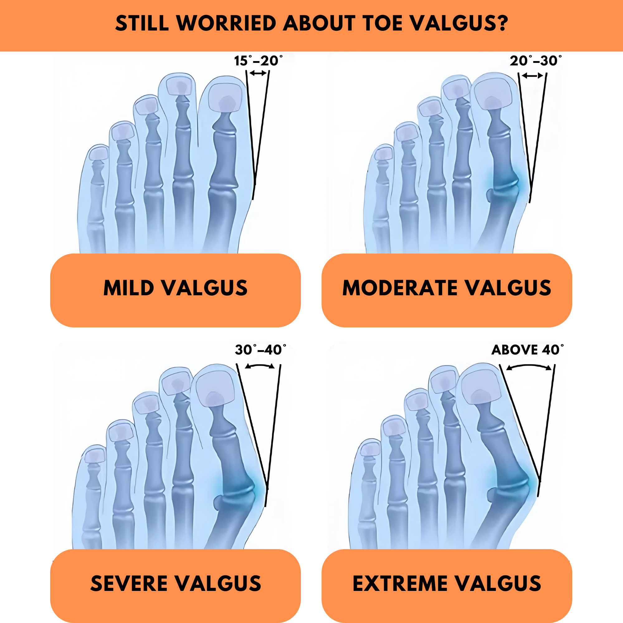 Orthopaedic Toe Bunion Corrector